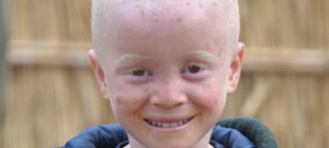 This is a headshot image of a child with albinism