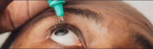 Image of a person applying eye drops to an irritated eye while treating conjunctivitis (Apollo)