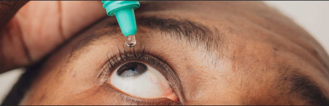 Image of a person applying eye drops to an irritated eye while treating conjunctivitis (Apollo)