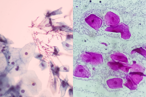 Microscopic images showing the difference between a yeast infection and bacterial vaginosis (BV).